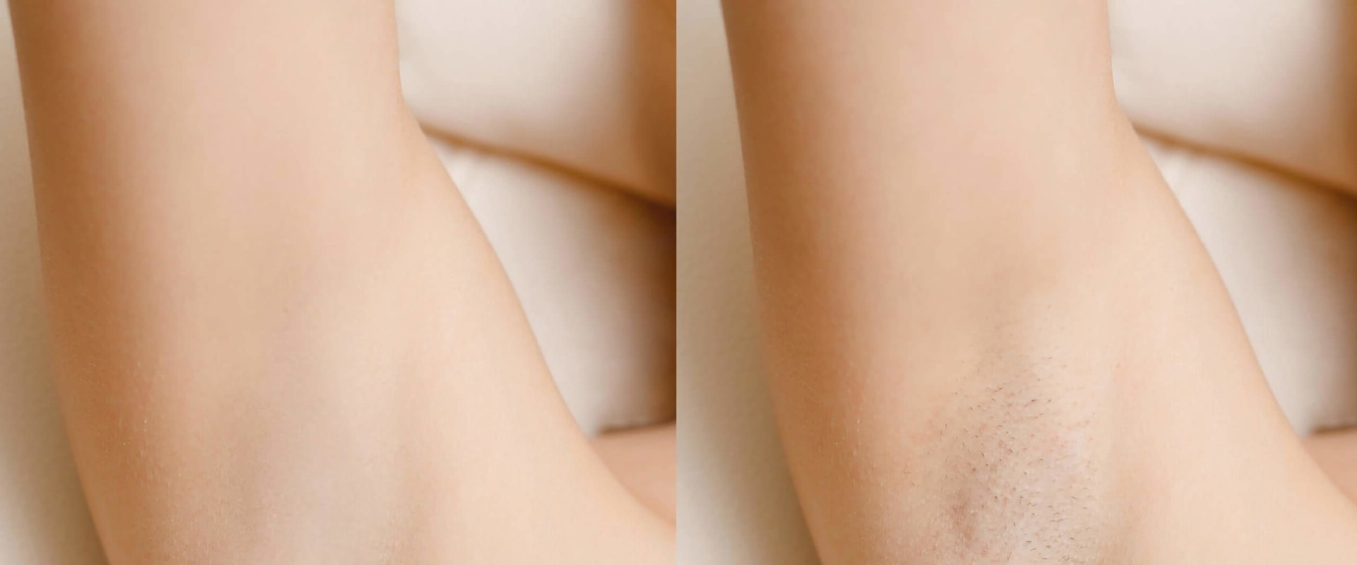 How Much Does Laser Hair Removal Cost for the Underarms?