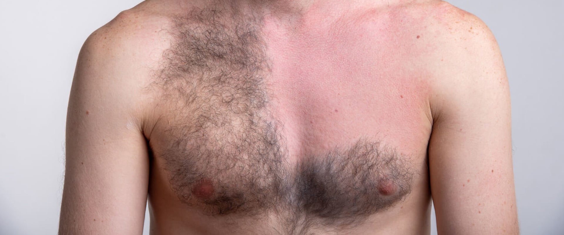 How Long Does Laser Hair Removal Last on Chest? A Comprehensive Guide