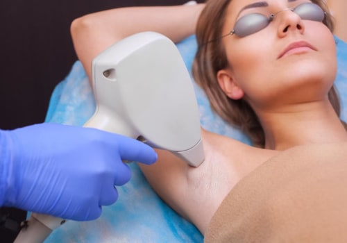 Is Laser Hair Removal Permanent After 10 Sessions?