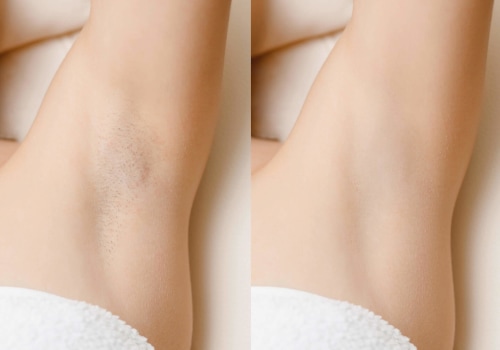 What is the Cost of Laser Hair Removal for the Arms?
